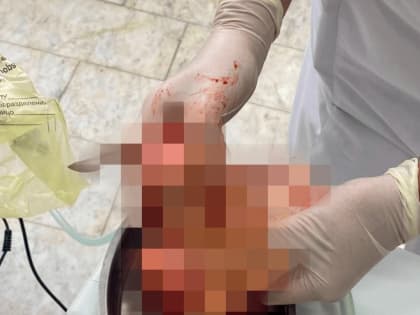 В Уфе врачи удалили у молодой девушки гигантскую опухоль матки