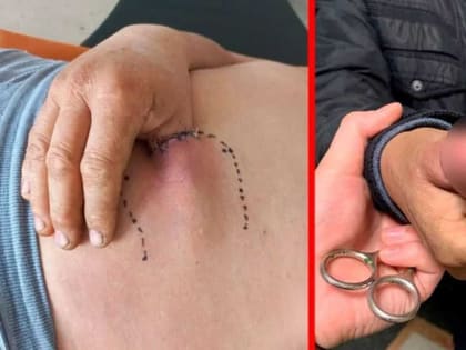В Стерлитамаке хирурги спасли изувеченный палец токаря, вживив его в живот пациента