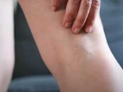 Растительный компресс для борьбы с варикозом и тромбозом: рецепт от флеболога Осиповой