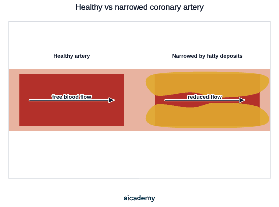 Two coronary arteries side by side: the healthy one has a wide open channel with free blood flow, while the other is narrowed by yellow fatty deposits along both walls, so the flow through it is reduced.