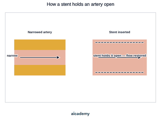 An artery narrowed by fatty deposits on both walls, shown next to the same artery after a mesh tube has been fitted inside it, holding the walls apart so blood flow to the heart muscle is restored.