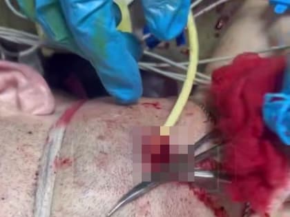 Тульские военные медики спасли пациента с 10-сантиметровым тромбом в сонной артерии