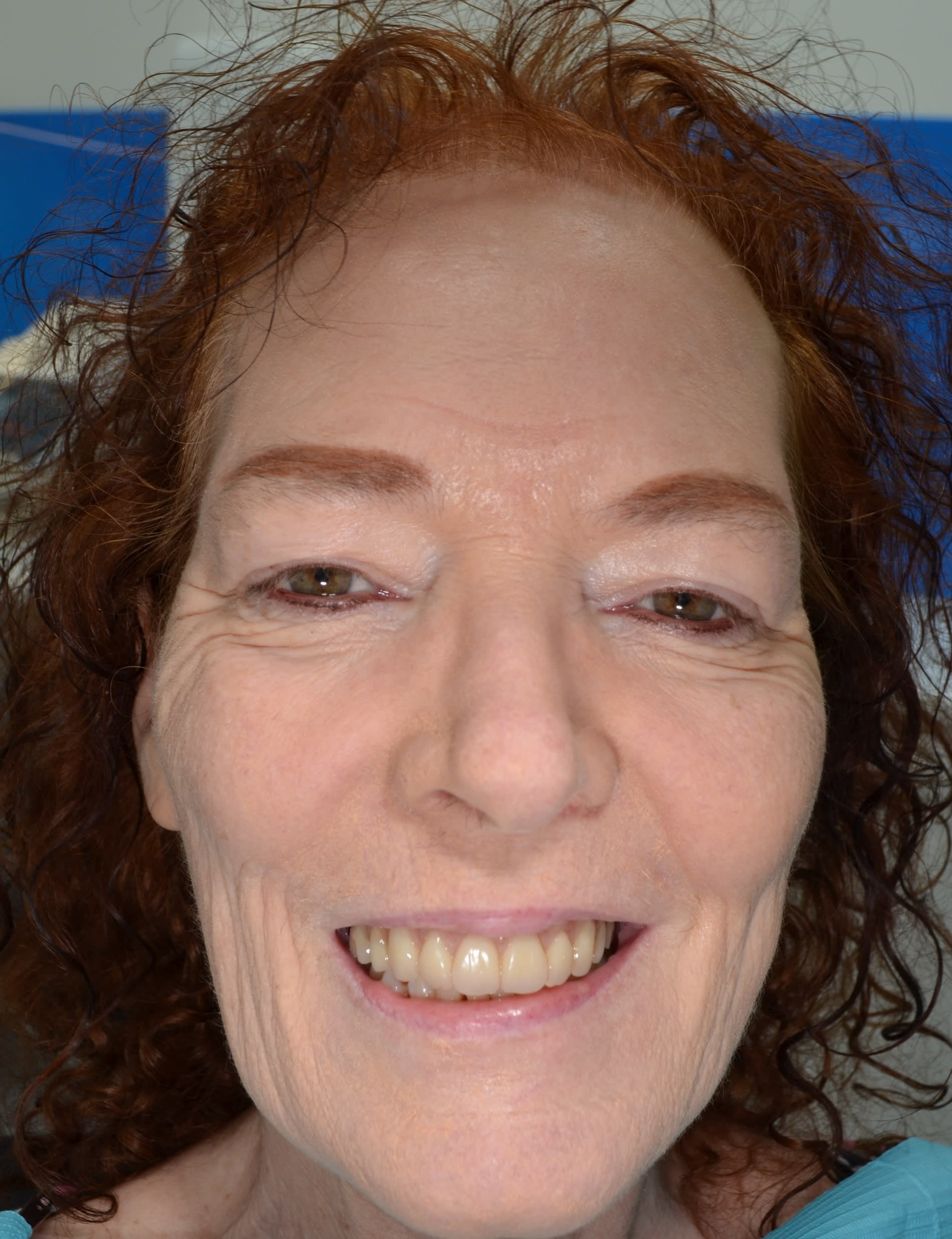 After full-arch implant treatment — case 1