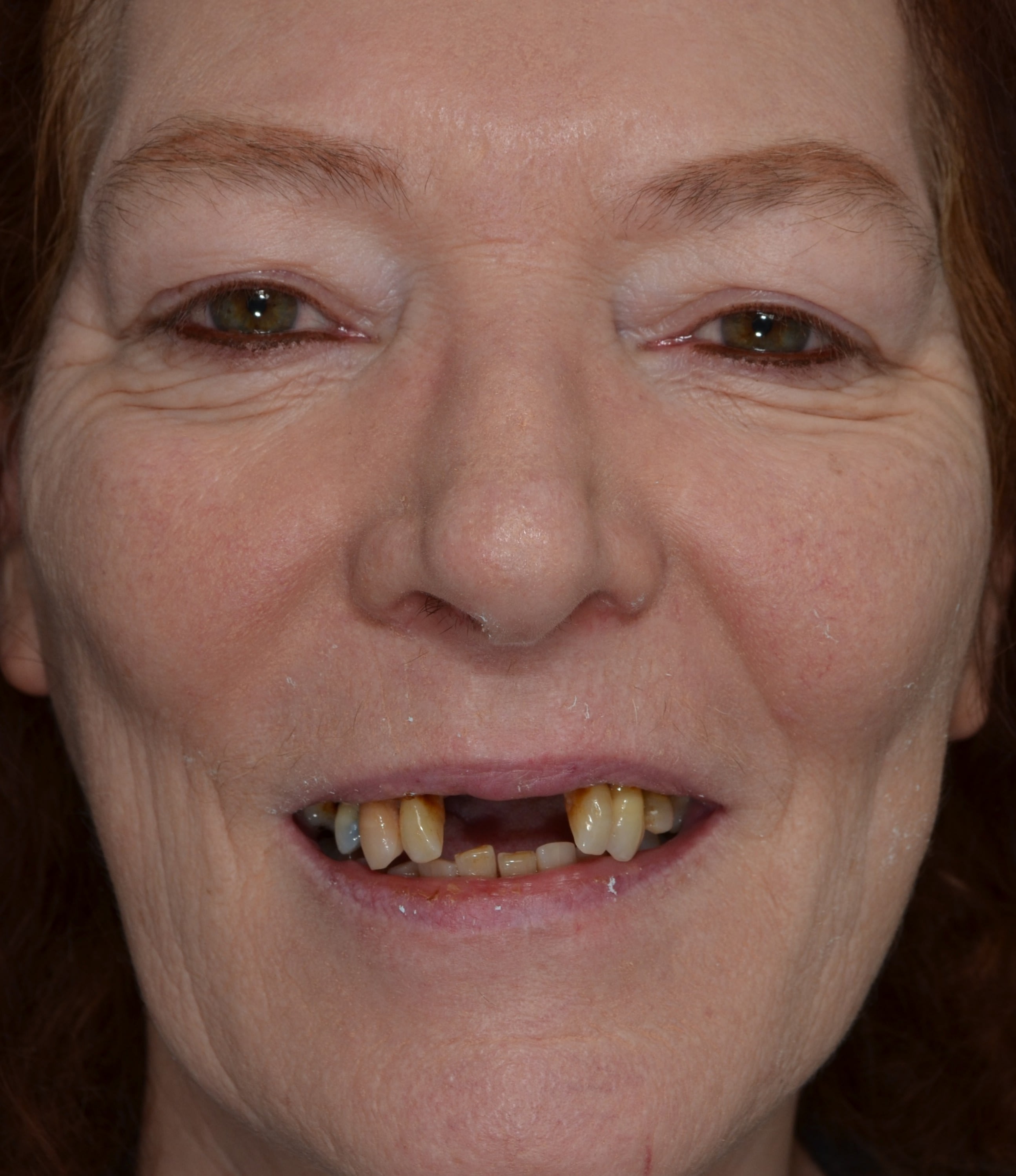 Before full-arch implant treatment — case 1