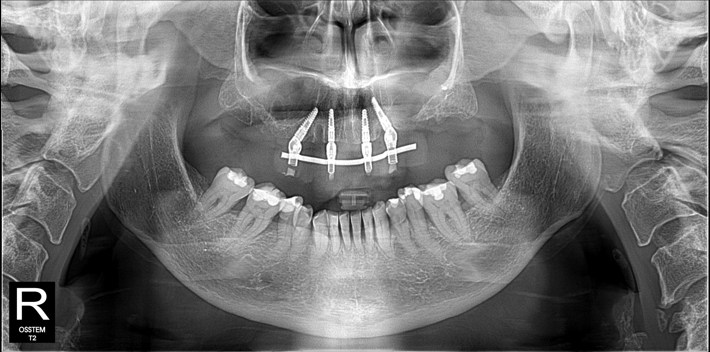 X-ray — case 1