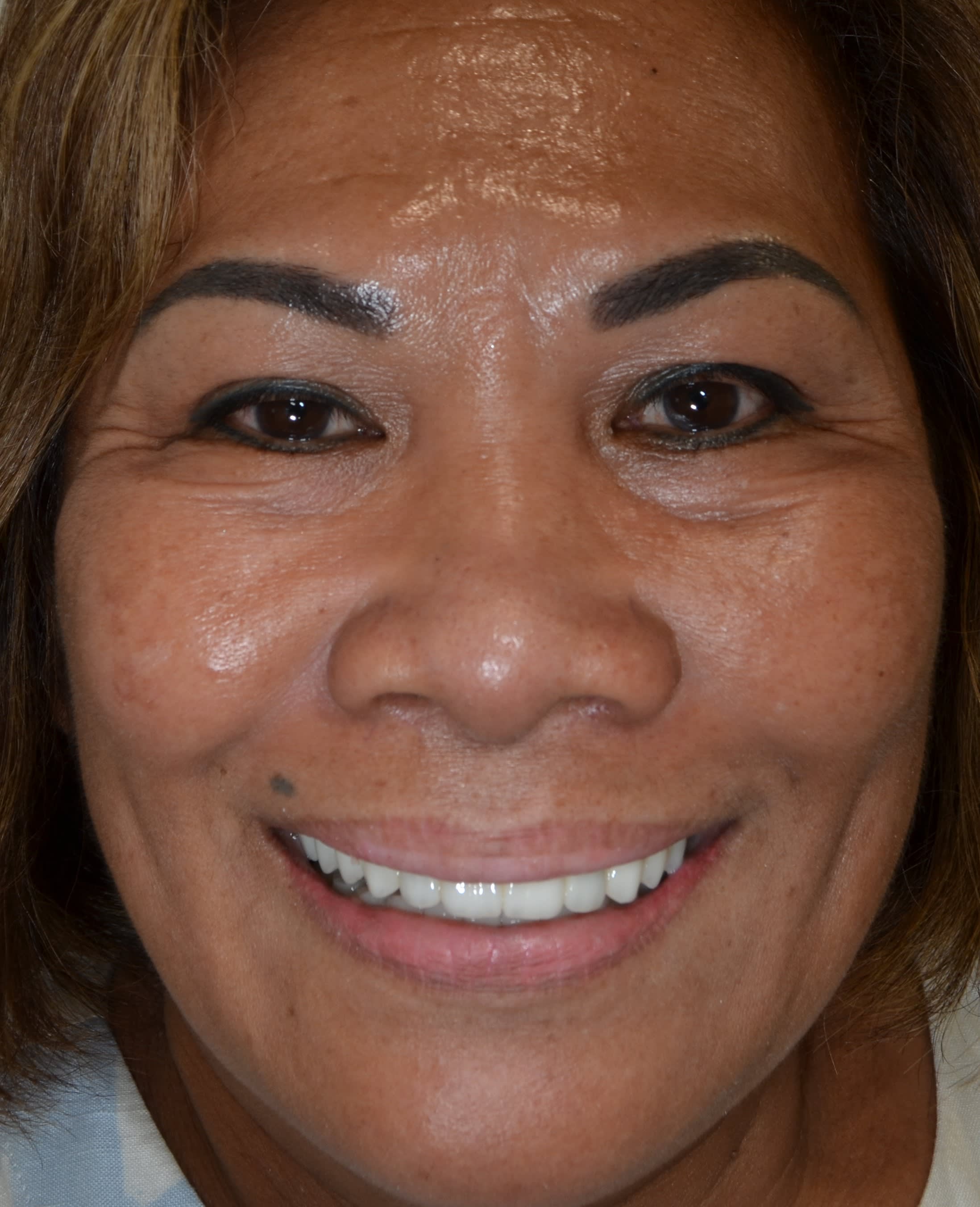After full-arch implant treatment — case 2