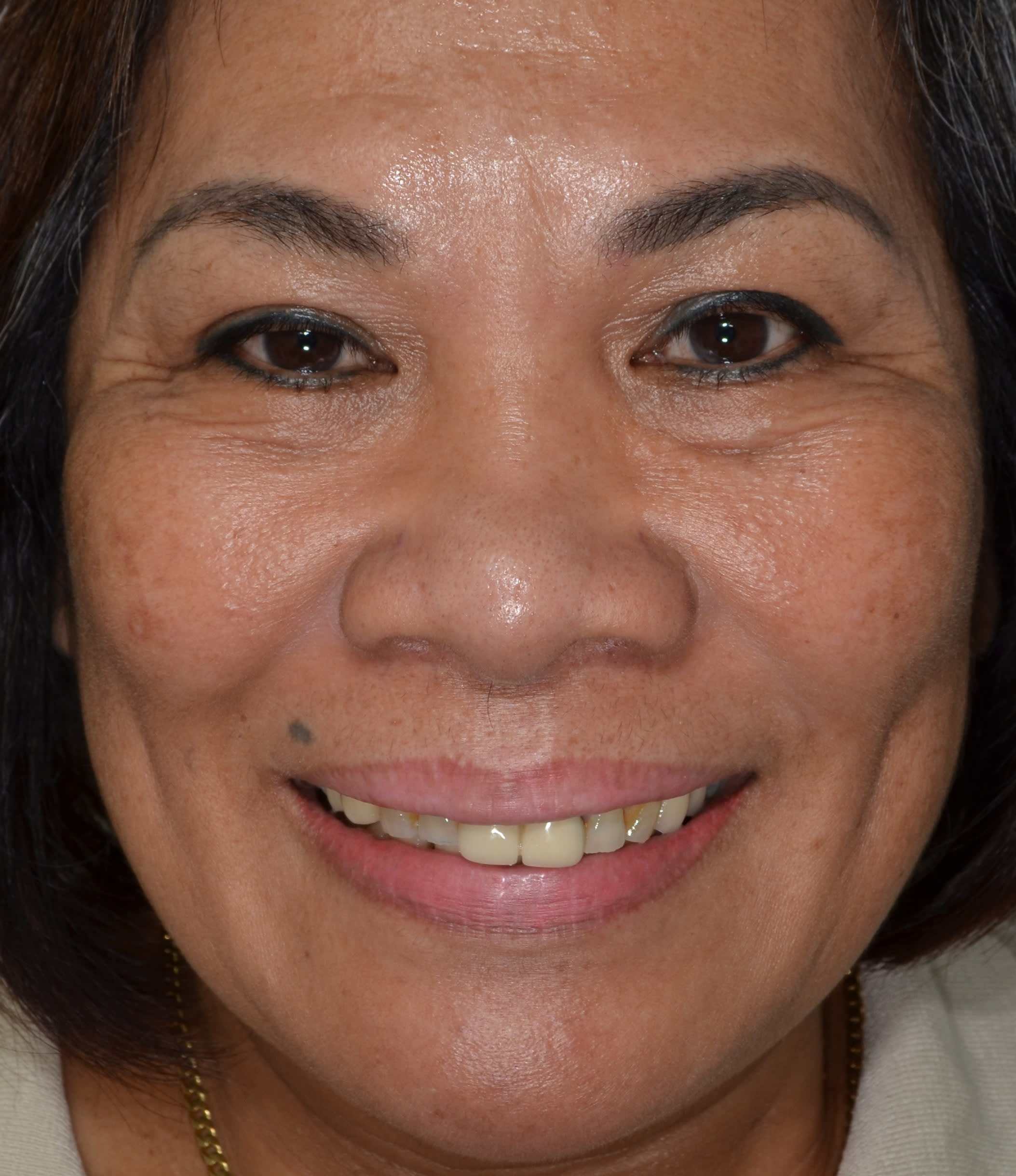 Before full-arch implant treatment — case 2