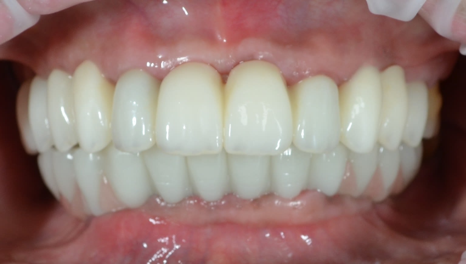 After · close-up — case 2