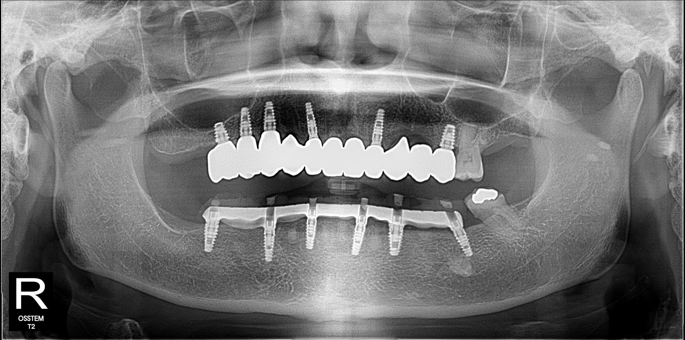 X-ray — case 2