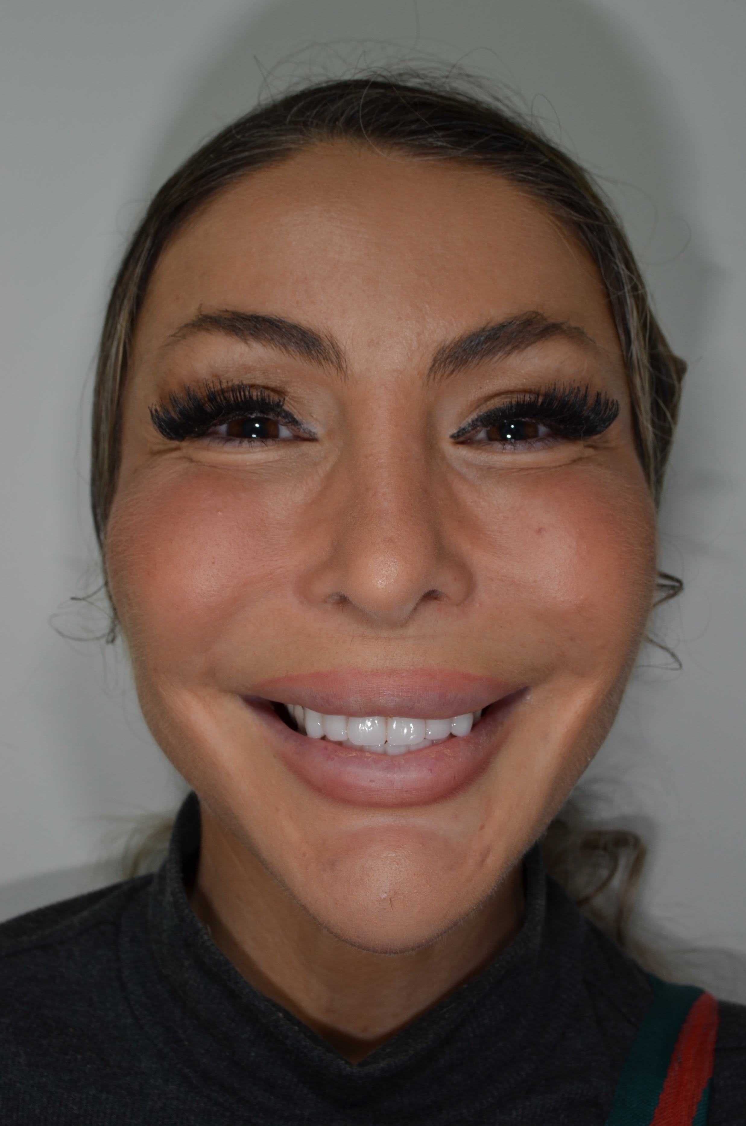 After full-arch implant treatment — case 3
