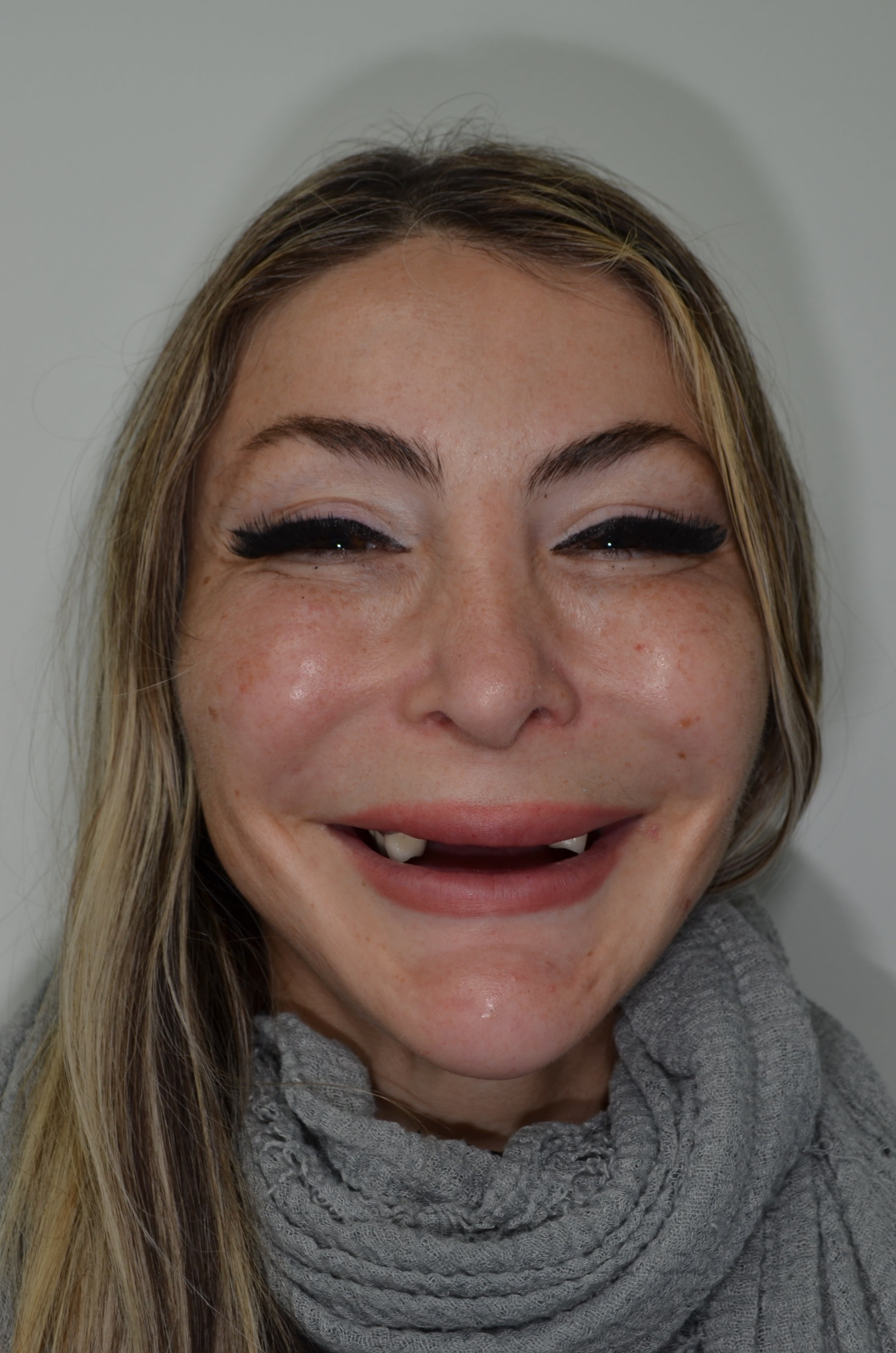 Before full-arch implant treatment — case 3