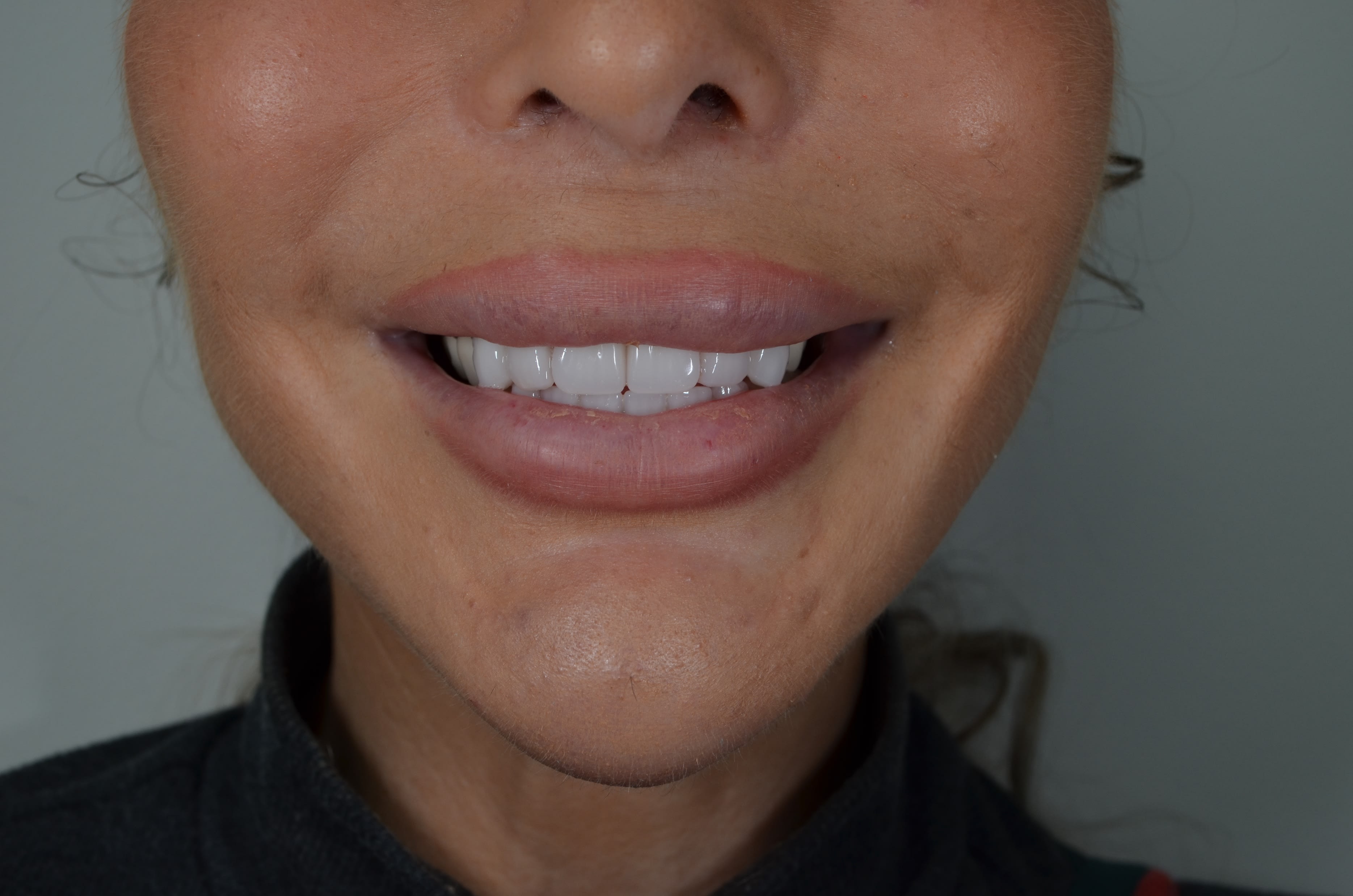 After · close-up — case 3