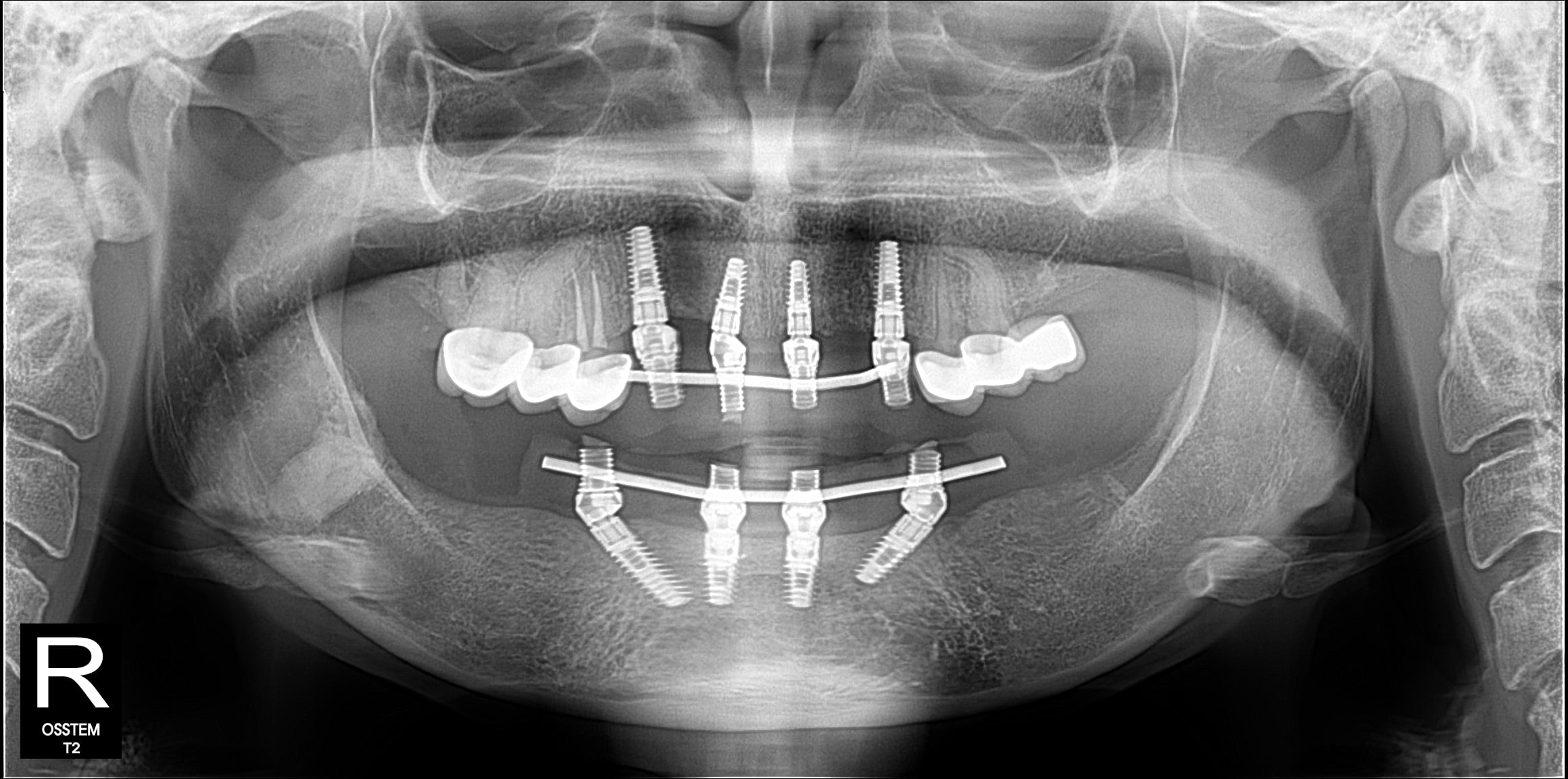 X-ray — case 3