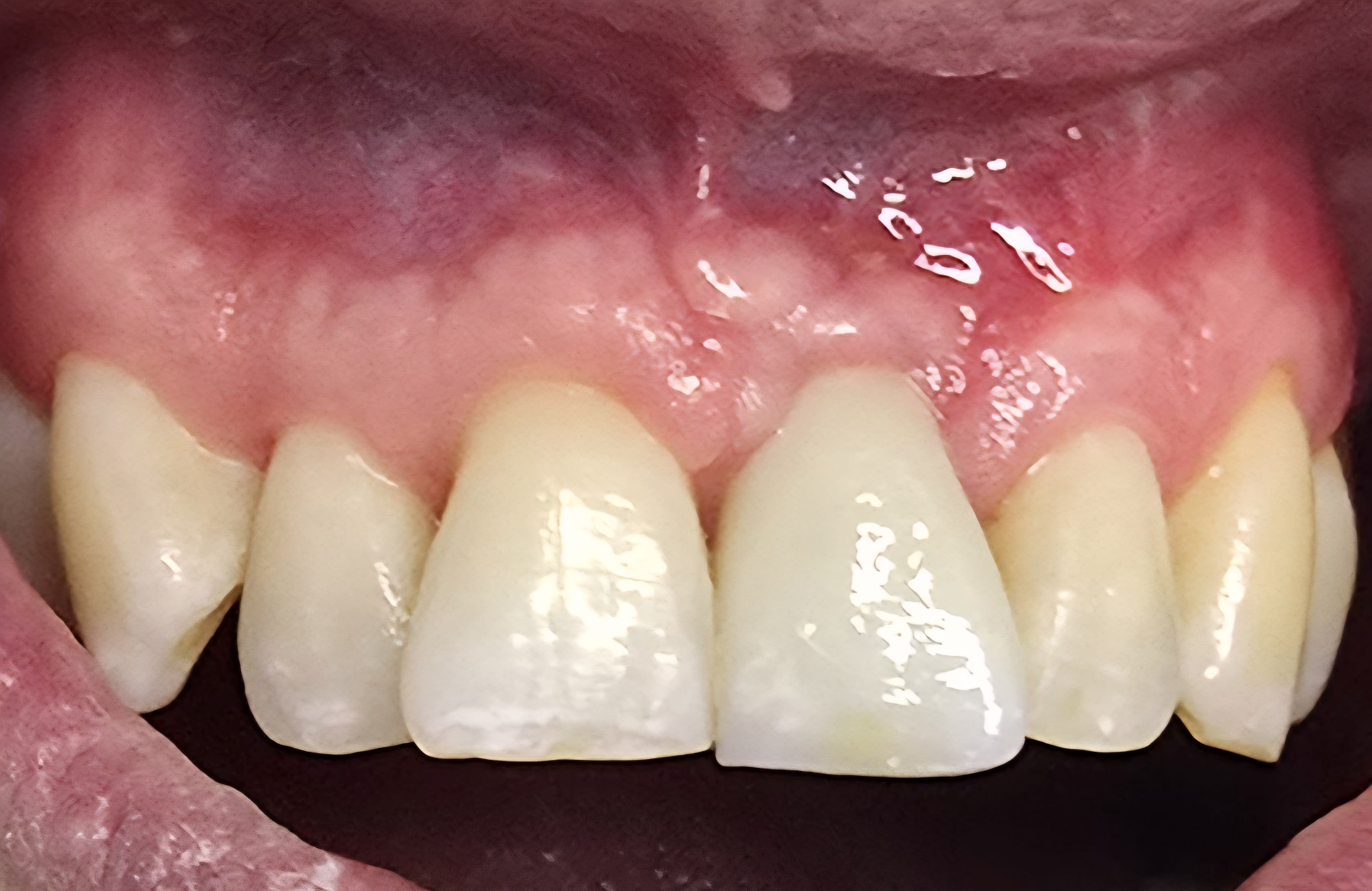After single tooth implants treatment — case 1