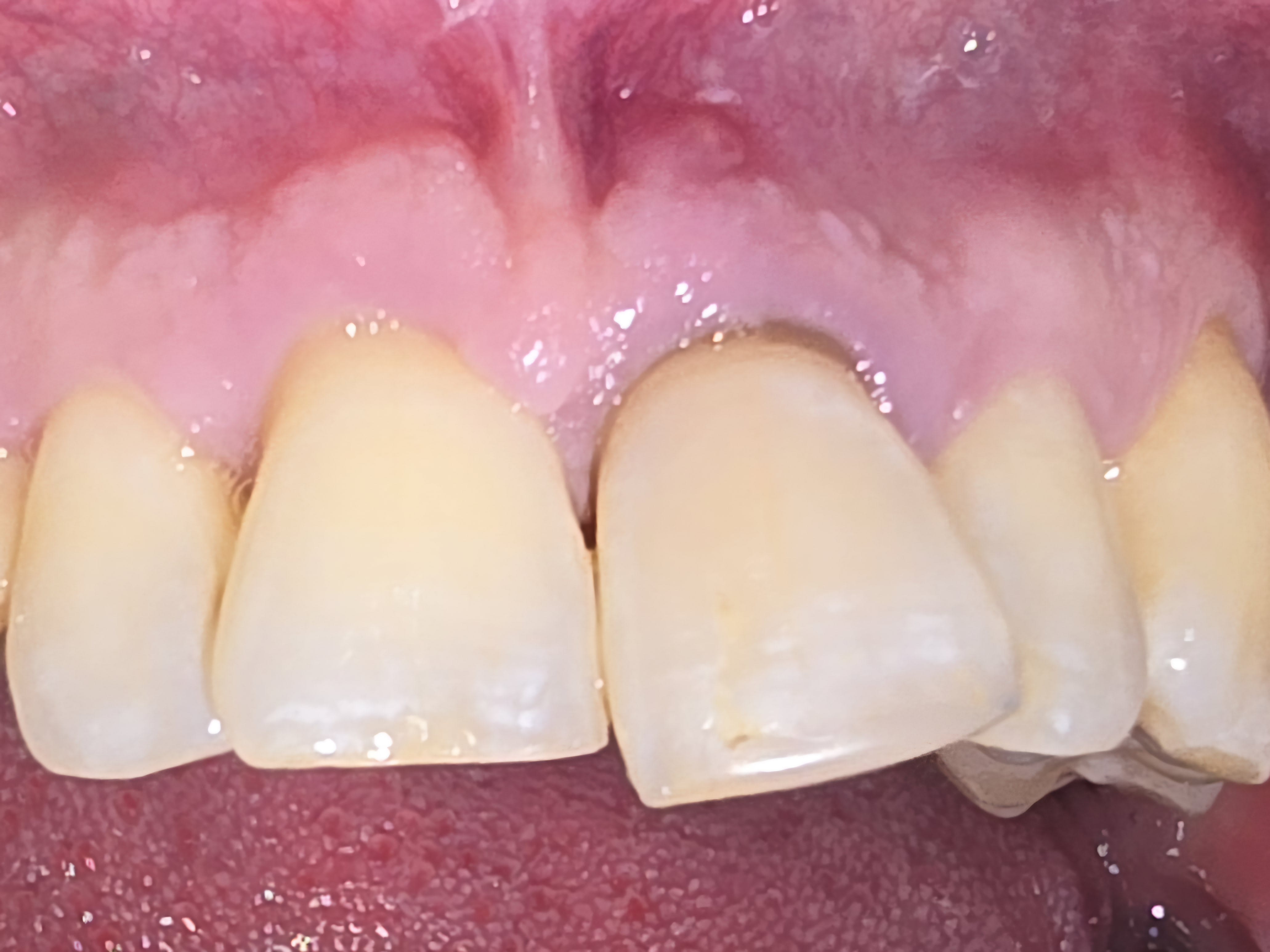 Before single tooth implants treatment — case 1