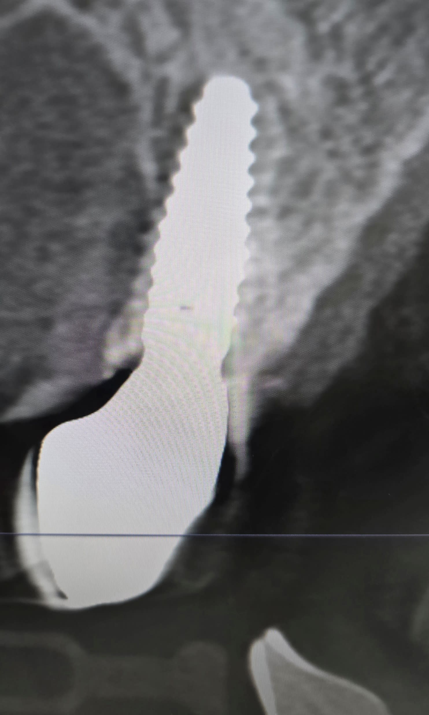 CBCT scan — case 1