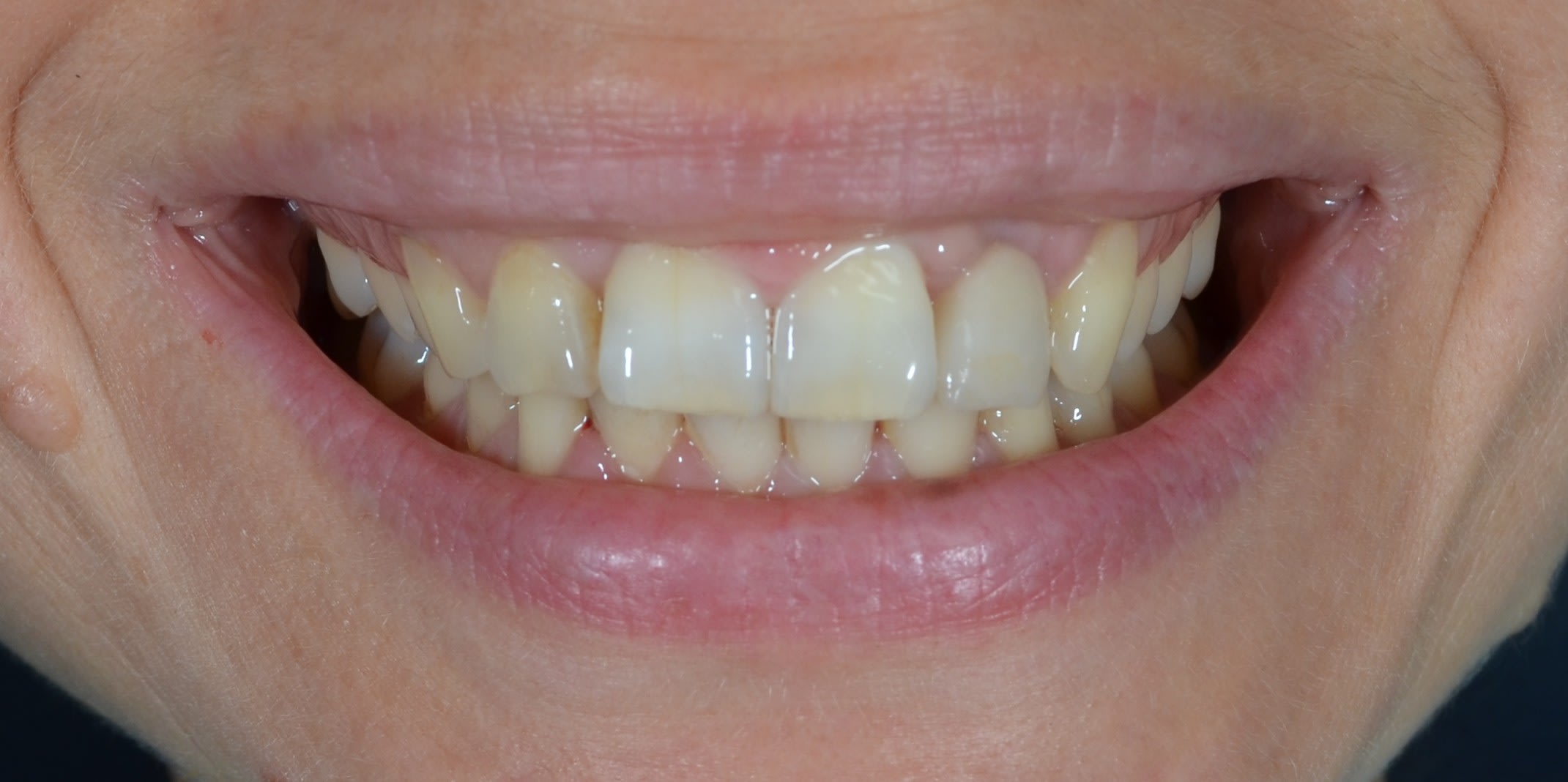 After single tooth implants treatment — case 2