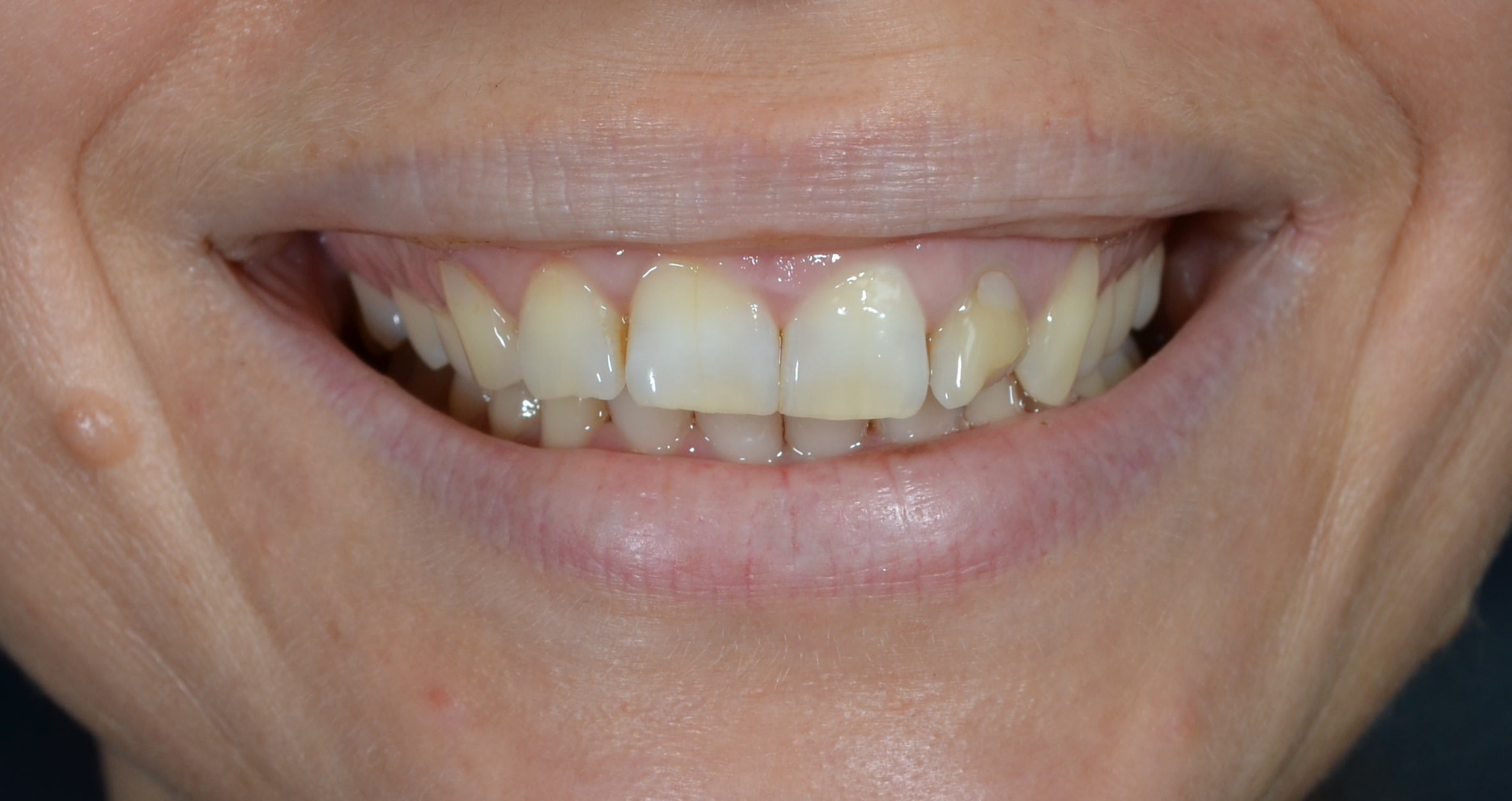 Before single tooth implants treatment — case 2