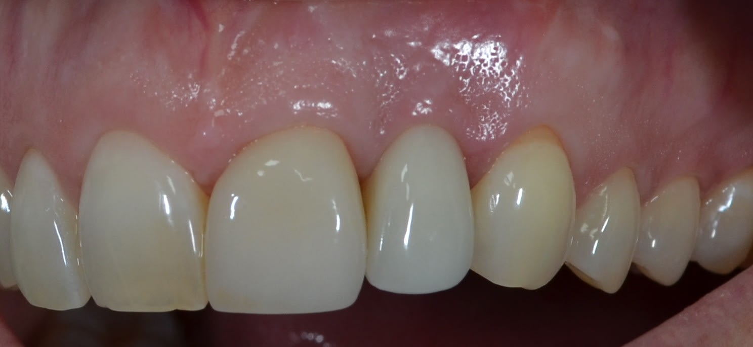 After single tooth implants treatment — case 3