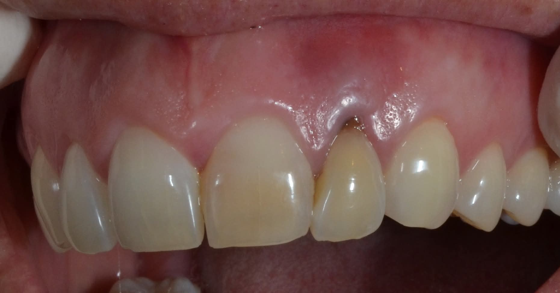 Before single tooth implants treatment — case 3