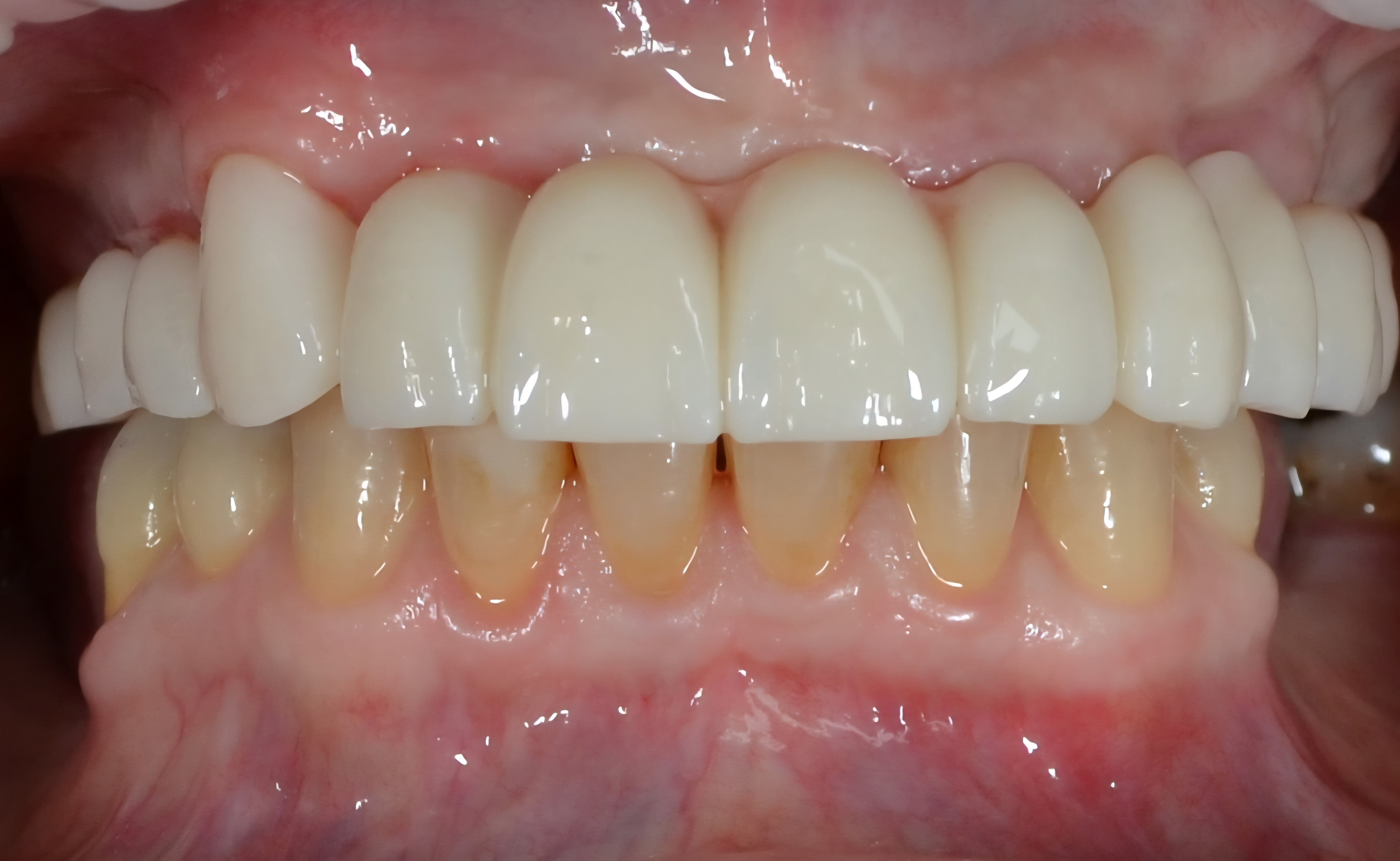 After single tooth implants treatment — case 4