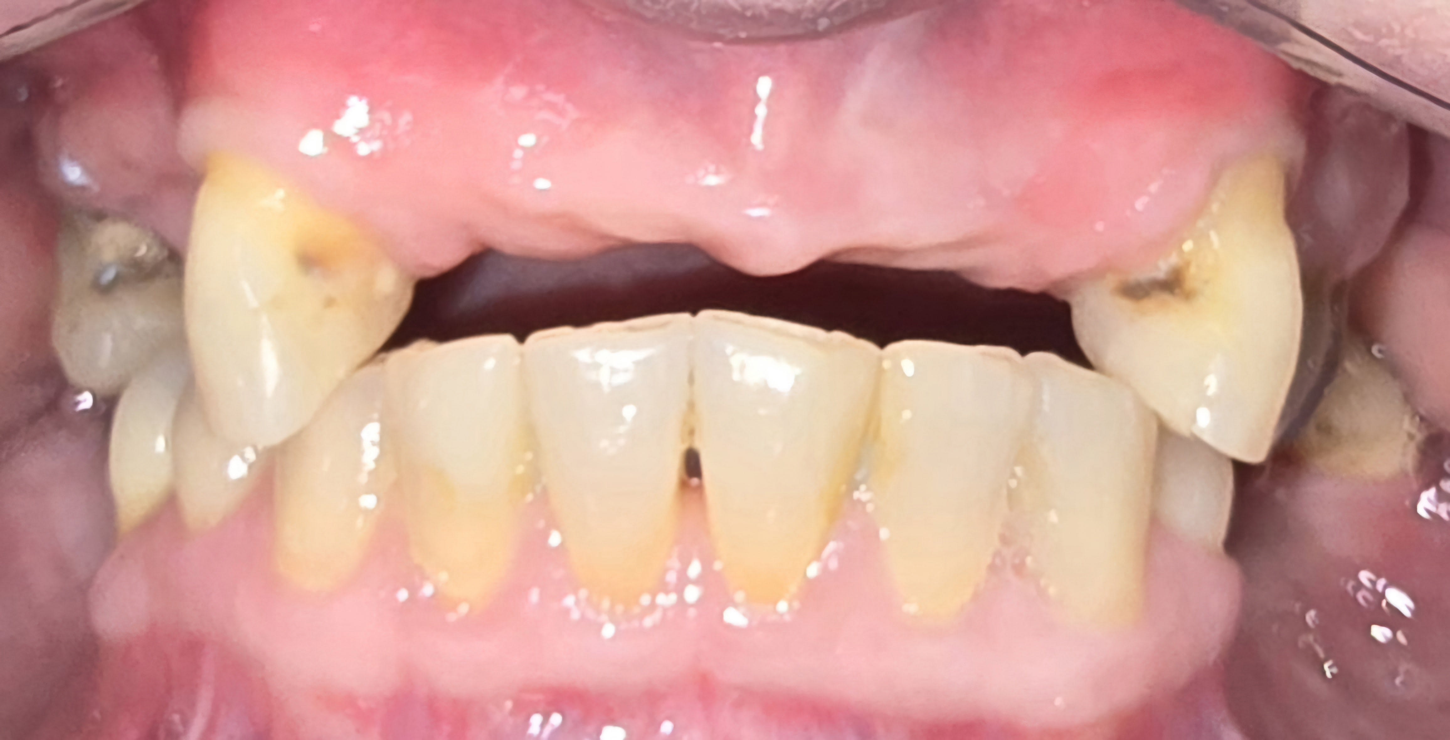 Before single tooth implants treatment — case 4