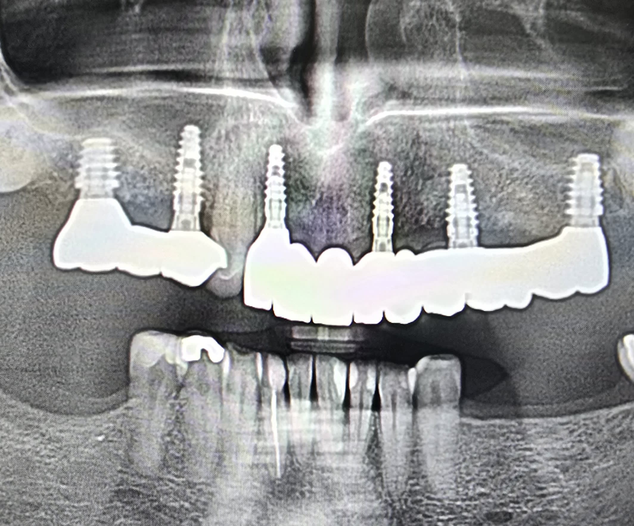 Panoramic X-ray — case 4