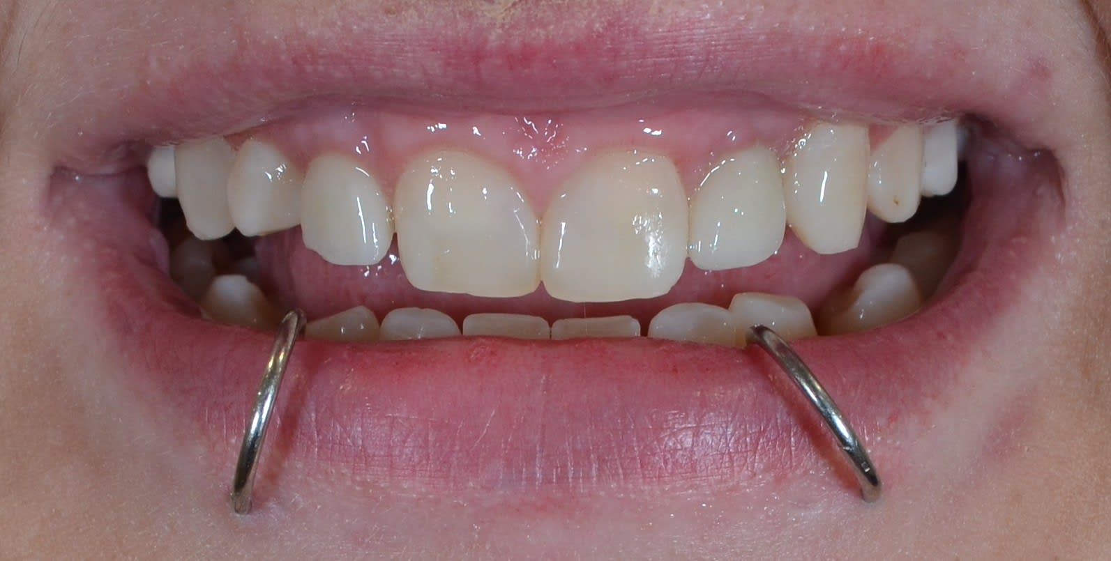 After single tooth implants treatment — case 5