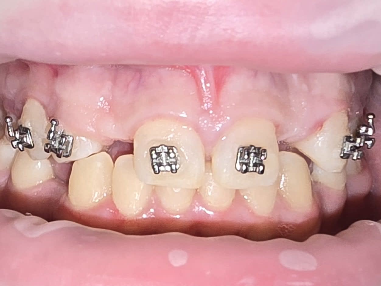 Before single tooth implants treatment — case 5