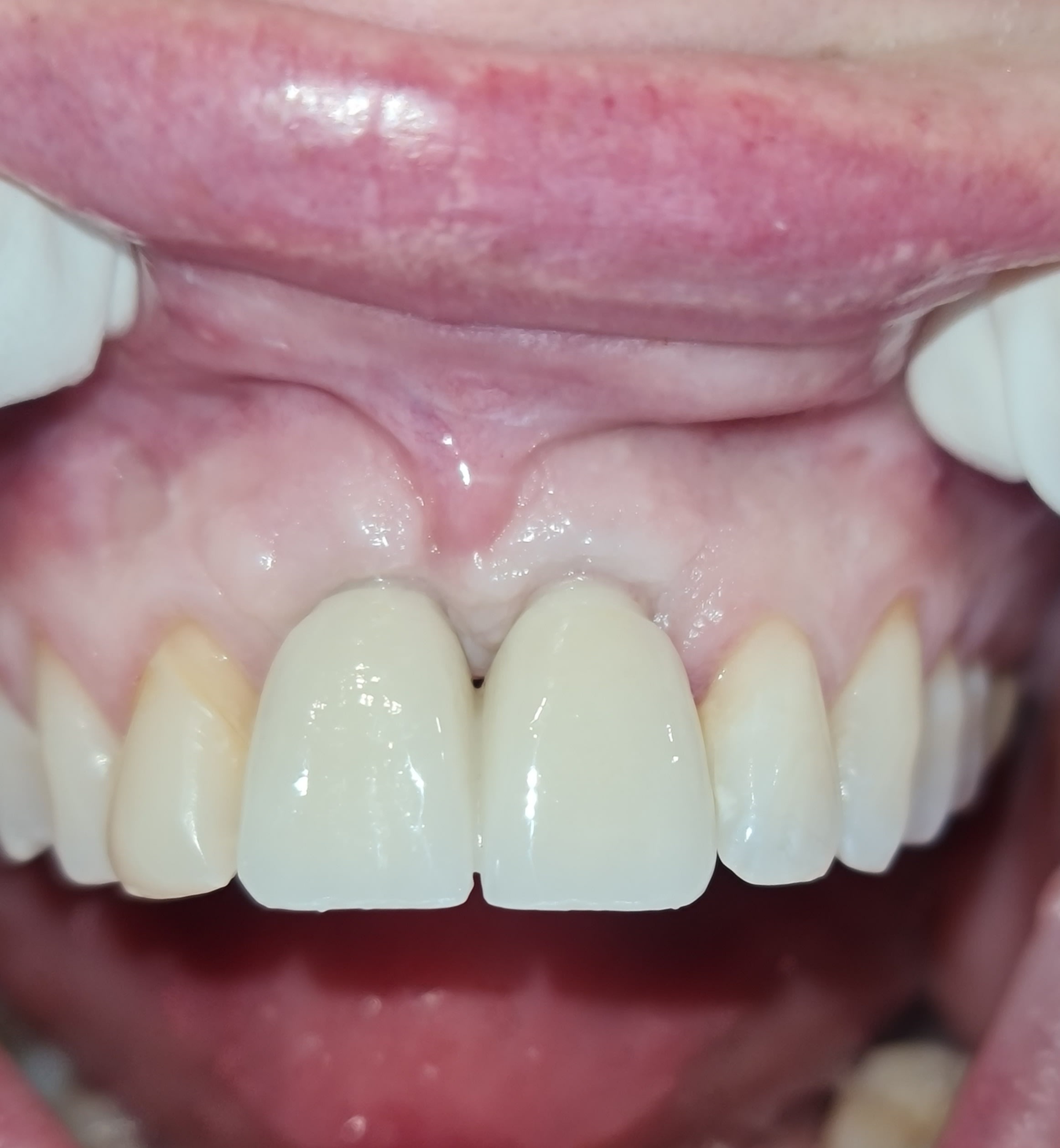 After single tooth implants treatment — case 6