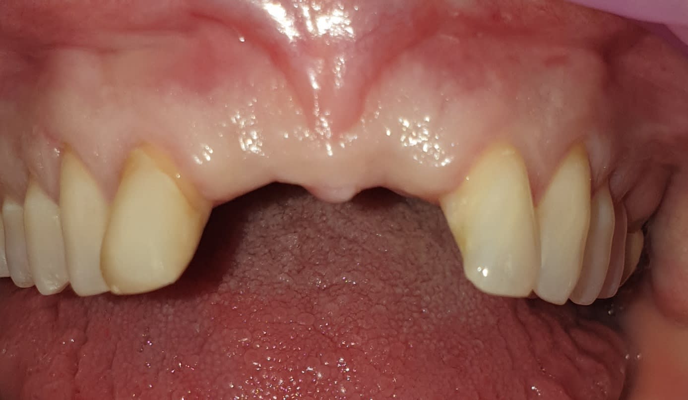 Before single tooth implants treatment — case 6