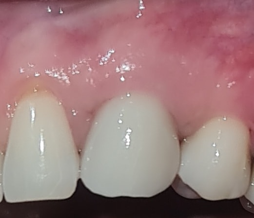 After zirconia (metal-free) implants treatment — case 1