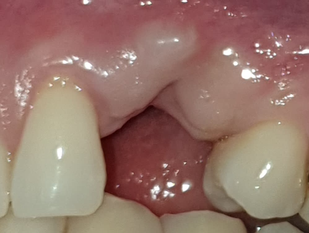 Before zirconia (metal-free) implants treatment — case 1