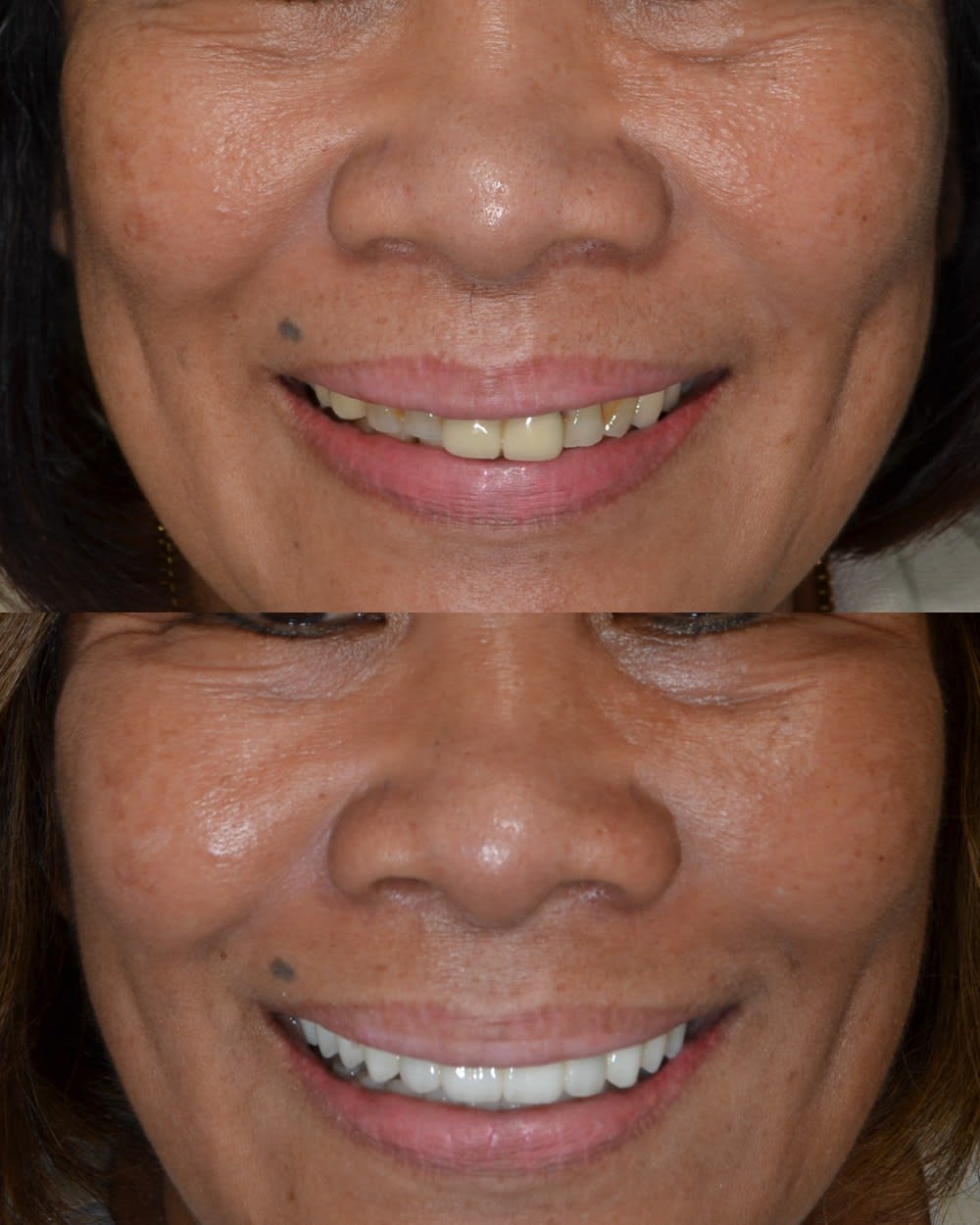 All on Implants — Implants case photo from our practice