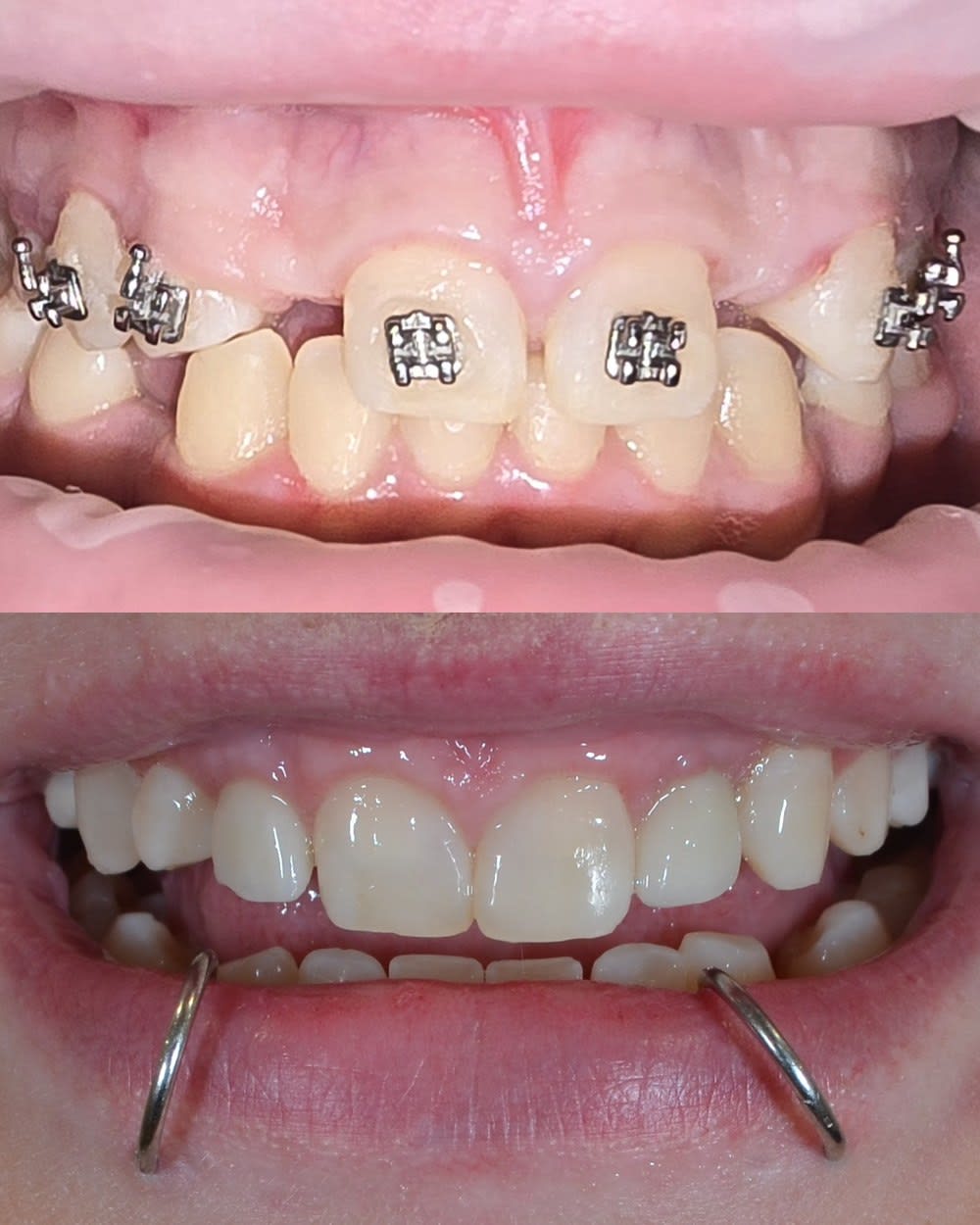 Braces and Implants — Orthodontics case photo from our practice