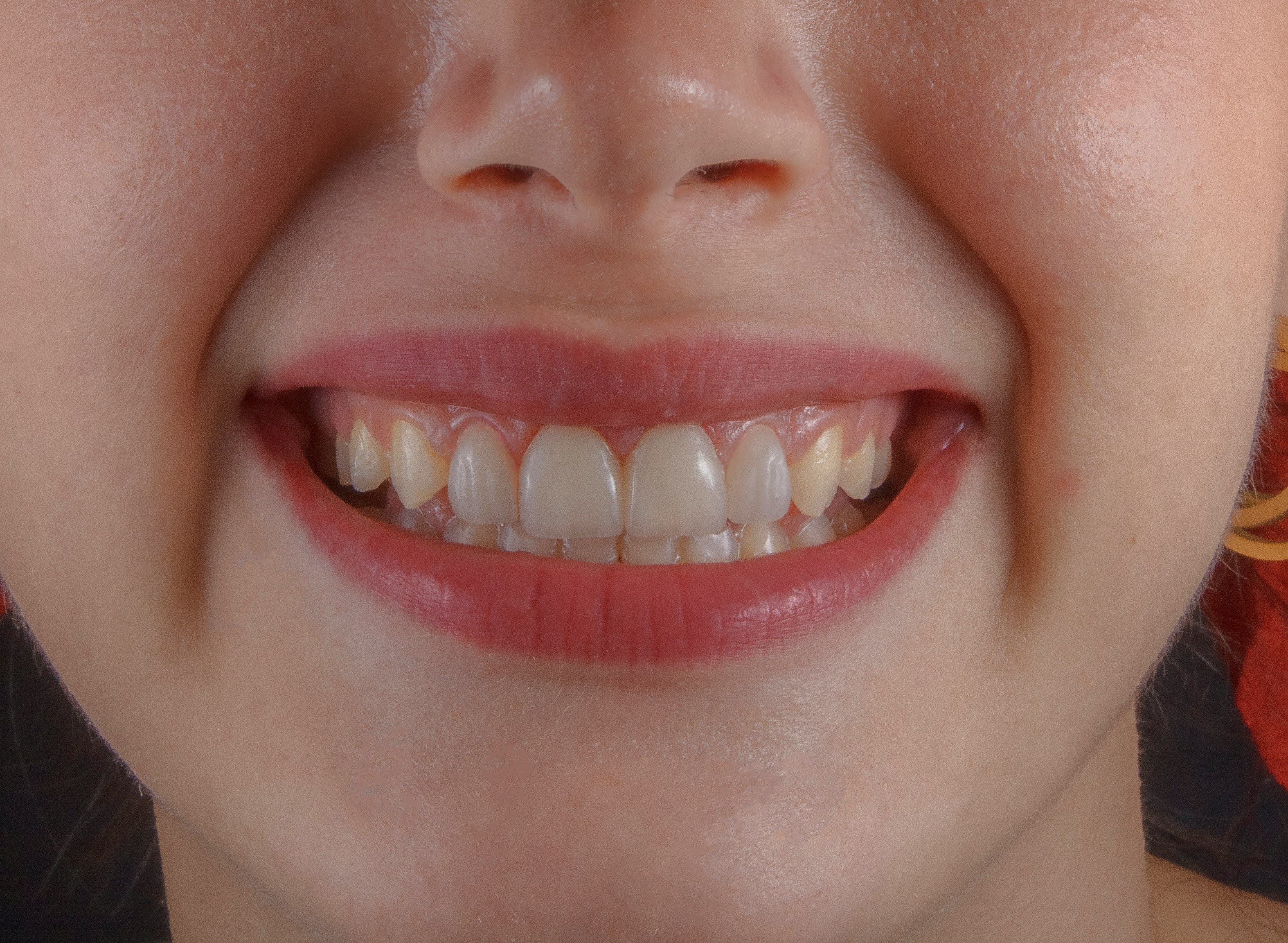 Early Interventive Orthodontics