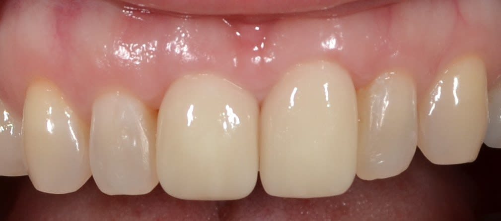 After composite bonding treatment — case 1