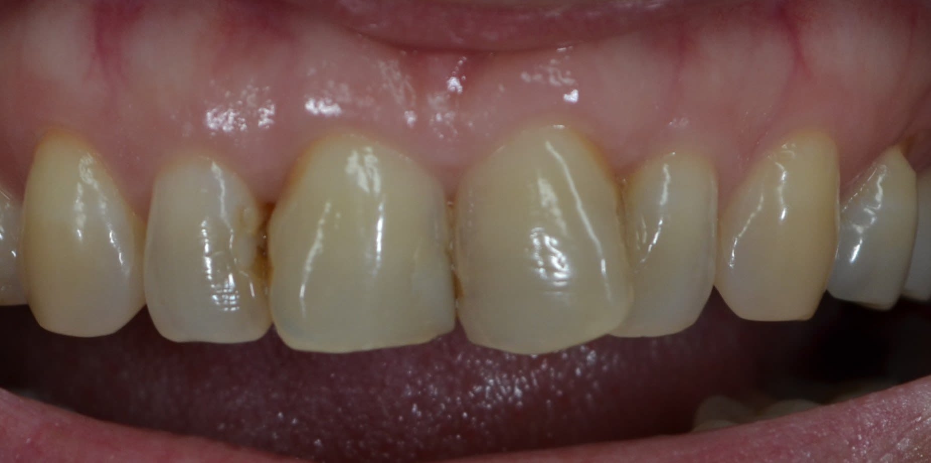 Before composite bonding treatment — case 1
