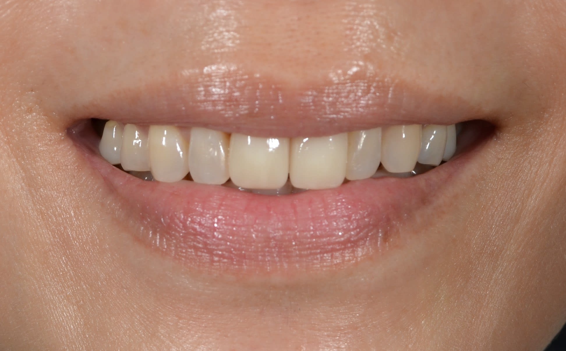 After composite bonding treatment — case 2