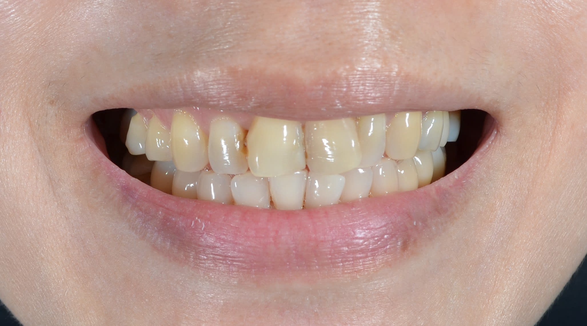 Before composite bonding treatment — case 2