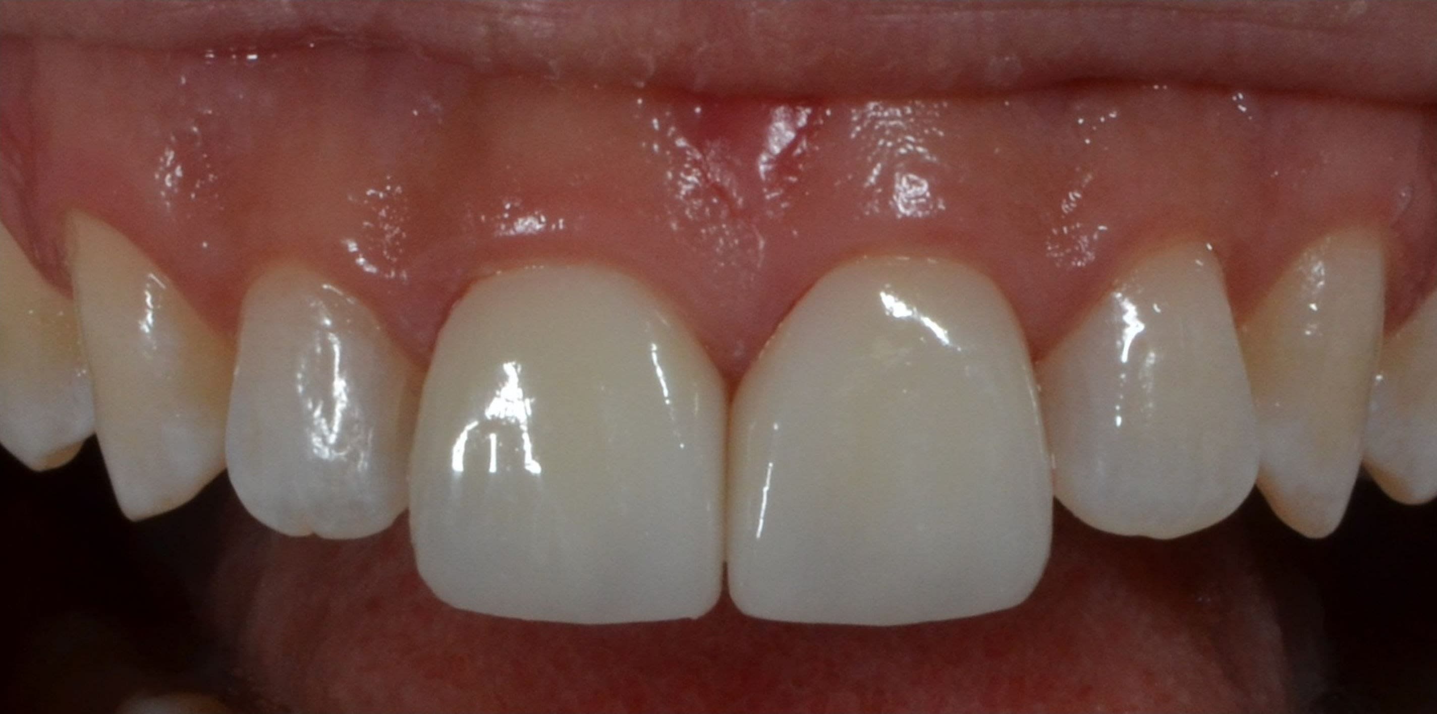 After composite bonding treatment — case 3
