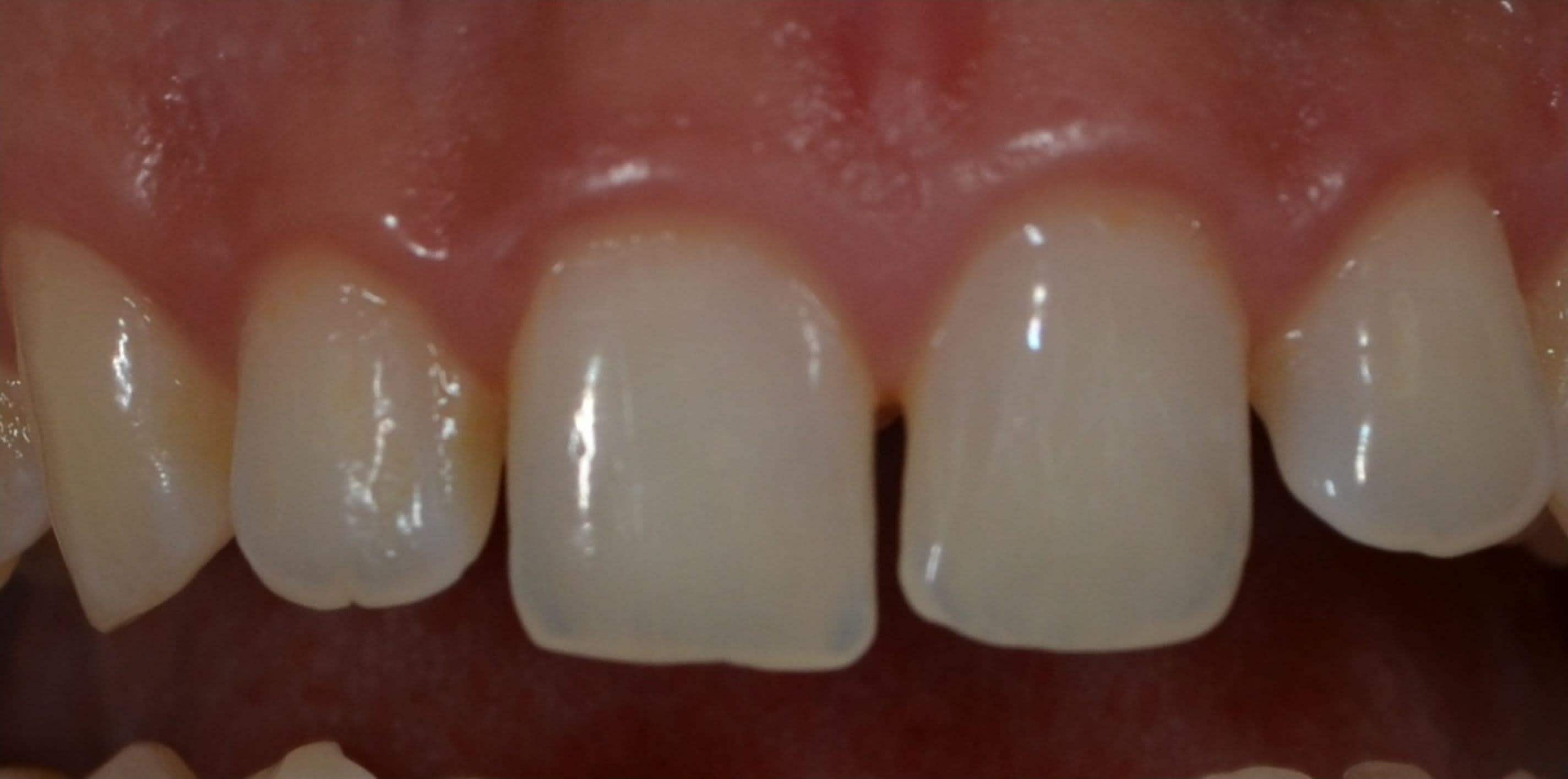 Before composite bonding treatment — case 3