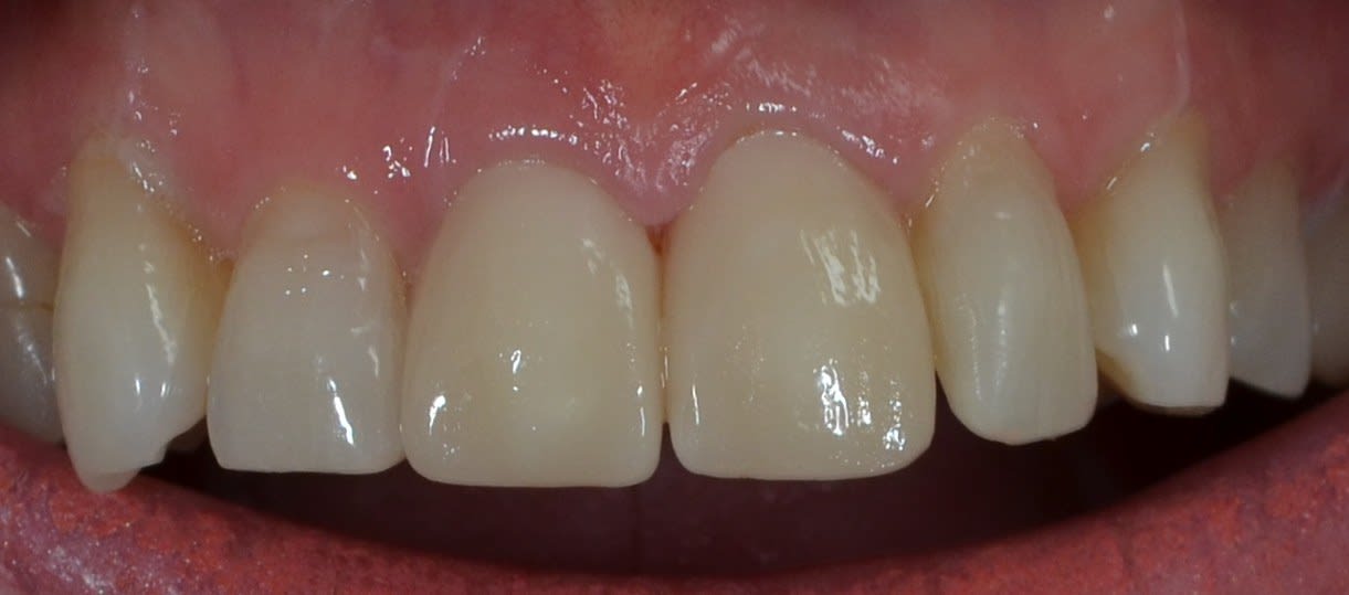 After composite bonding treatment — case 4
