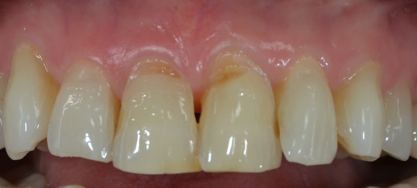 Before composite bonding treatment — case 4
