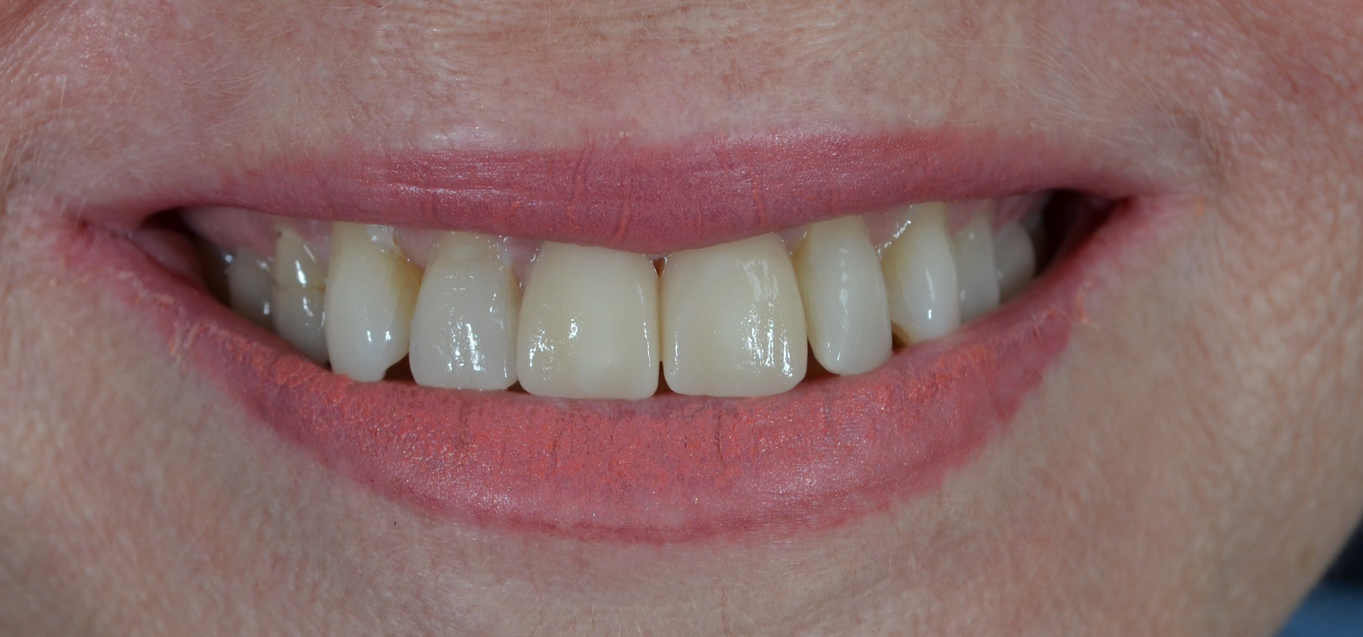 After composite bonding treatment — case 5