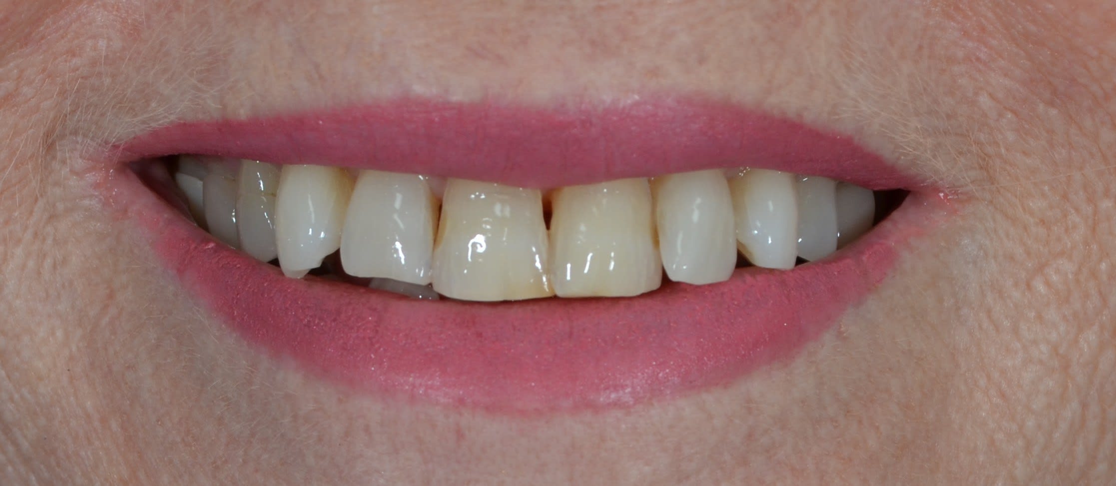 Before composite bonding treatment — case 5