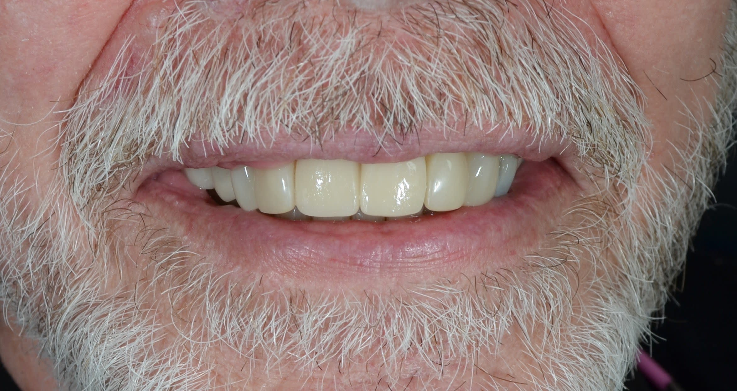 After composite bonding treatment — case 6