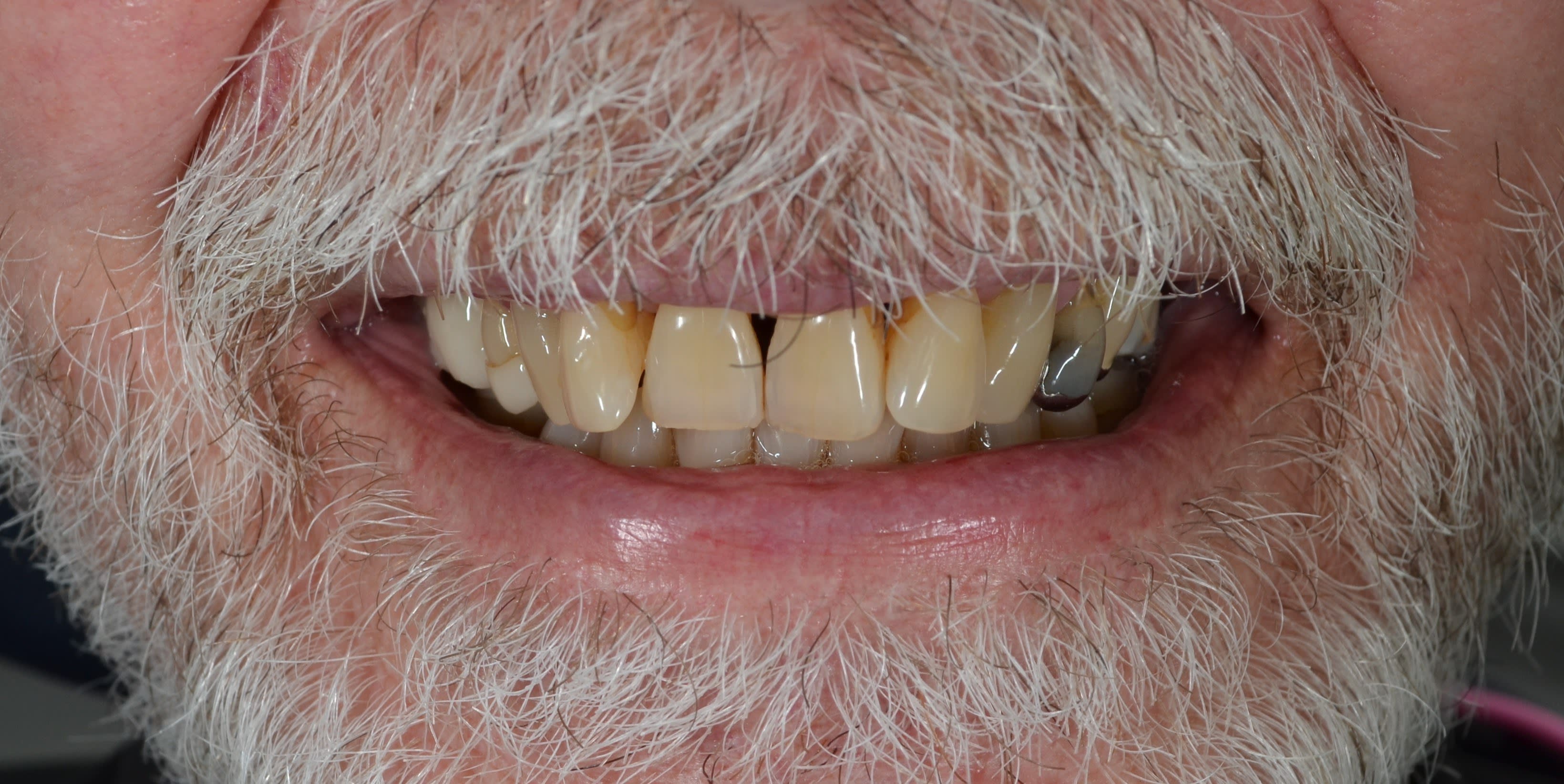 Before composite bonding treatment — case 6