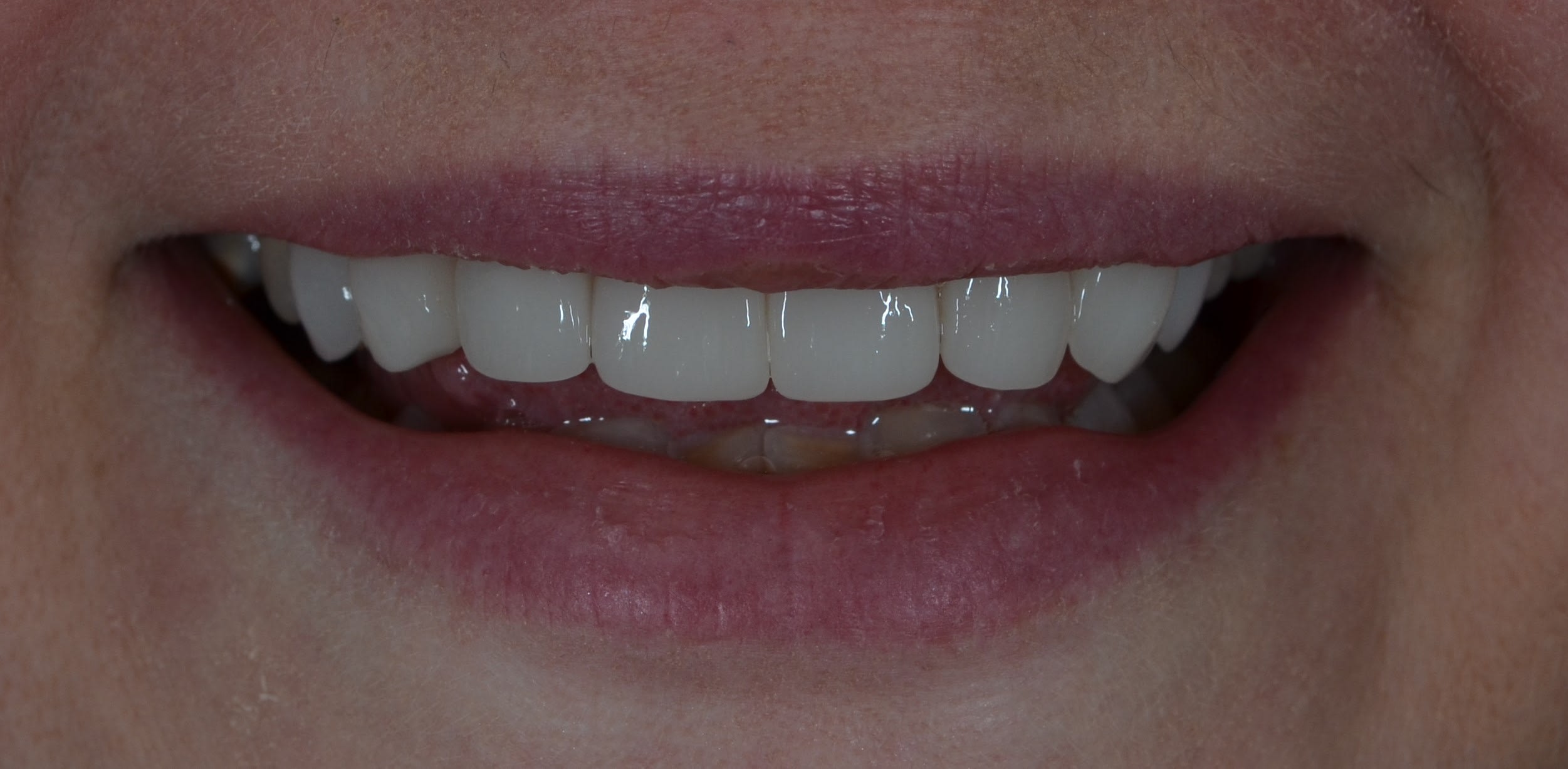 After same day veneers treatment — case 2