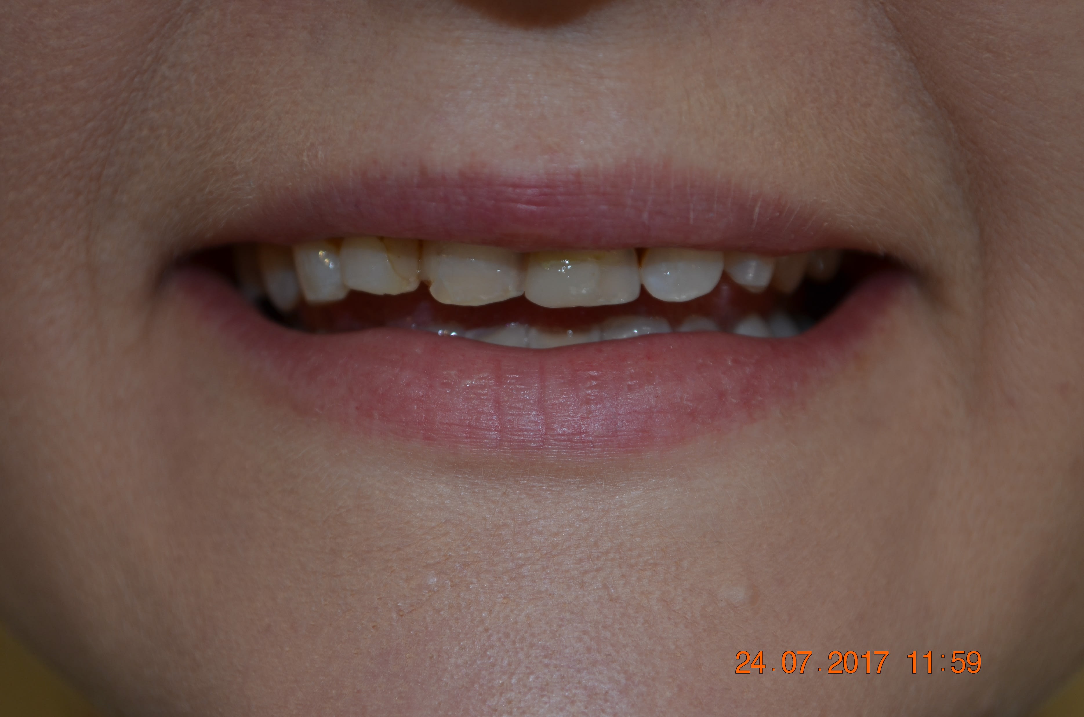 Before same day veneers treatment — case 2